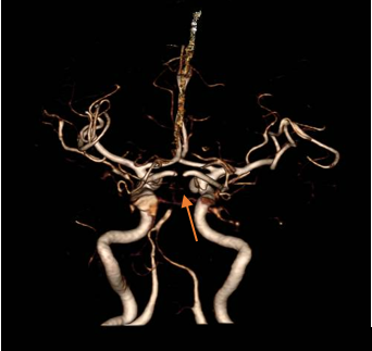 湾医万象之媒体聚焦丨 88 岁老人凌晨上厕所时突然僵住，罪魁祸首竟是这种特殊的脑梗