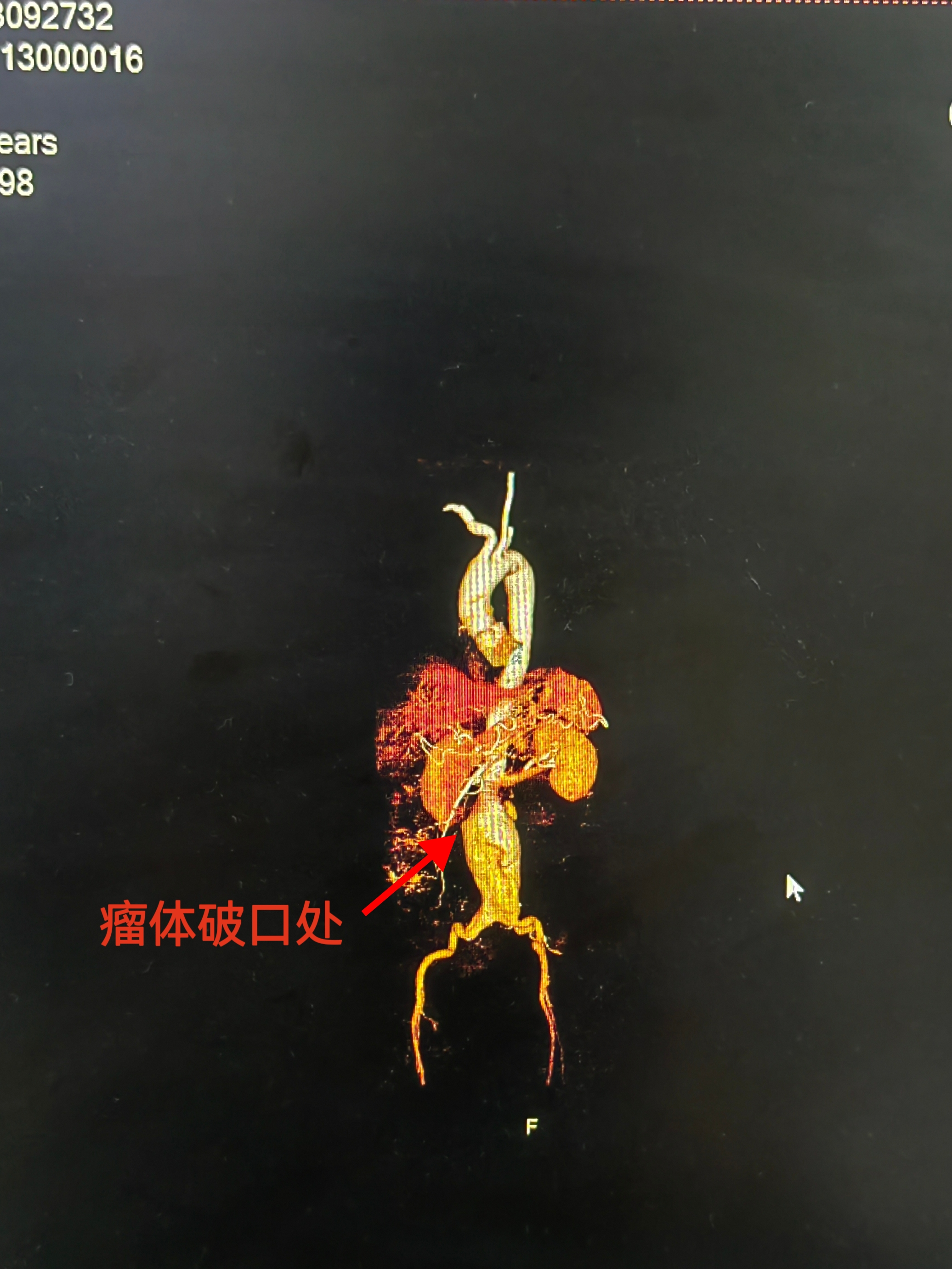 腹主动脉瘤破裂危在旦夕!南溪山医院血管外科精准「拆弹」力挽狂澜