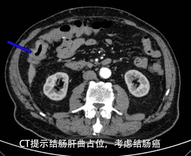 鄭州大學第五附屬醫院胃腸甲狀腺外科救治高齡結腸癌並心源性休克患者