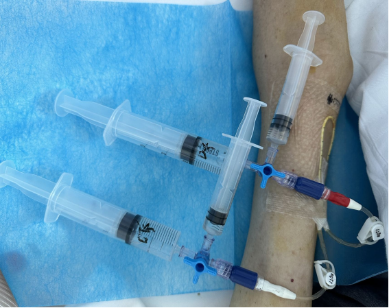 PICC 导管完全堵塞?延安市中医医院肿瘤科医护团队接力 8 小时顺利「疏通」 - 医院汇 - 丁香园