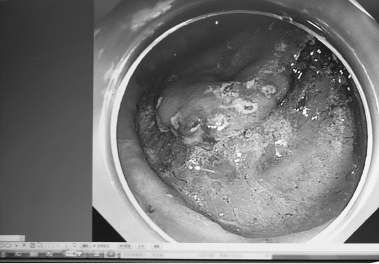 61 岁男子不幸患上胃癌 一个习惯让他「死里逃生」