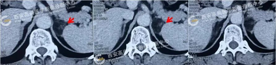 【高尚病例】肾上腺髓样脂肪瘤 1 例