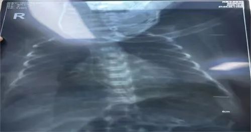 「搭建高原急危重症早产儿生命通道」——西藏阜康医院静疗学组完成技术突破