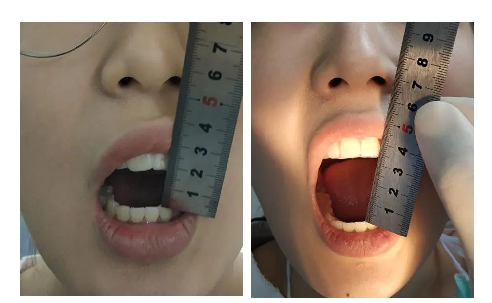 湾医科普丨「吃货」的烦恼——美食在眼前，我却张不开口......