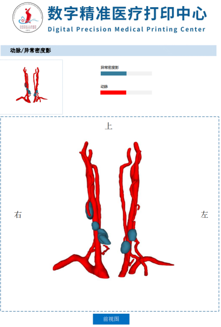 甲状腺术前三维重建规划,精准切除甲状腺癌