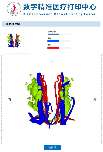 甲状腺术前三维重建规划,精准切除甲状腺癌