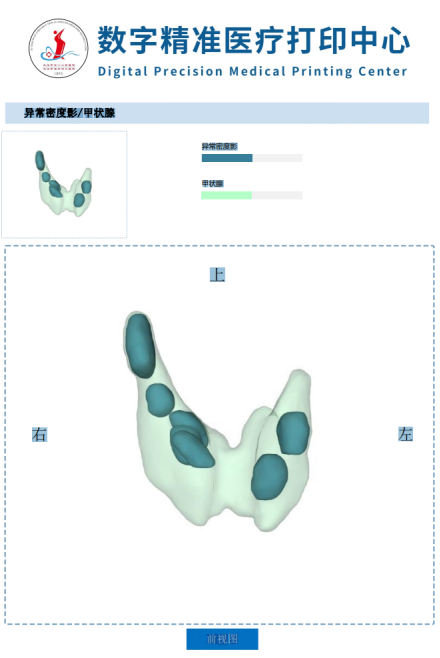甲状腺术前三维重建规划,精准切除甲状腺癌