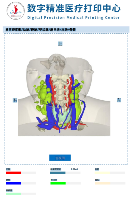 甲状腺术前三维重建规划,精准切除甲状腺癌