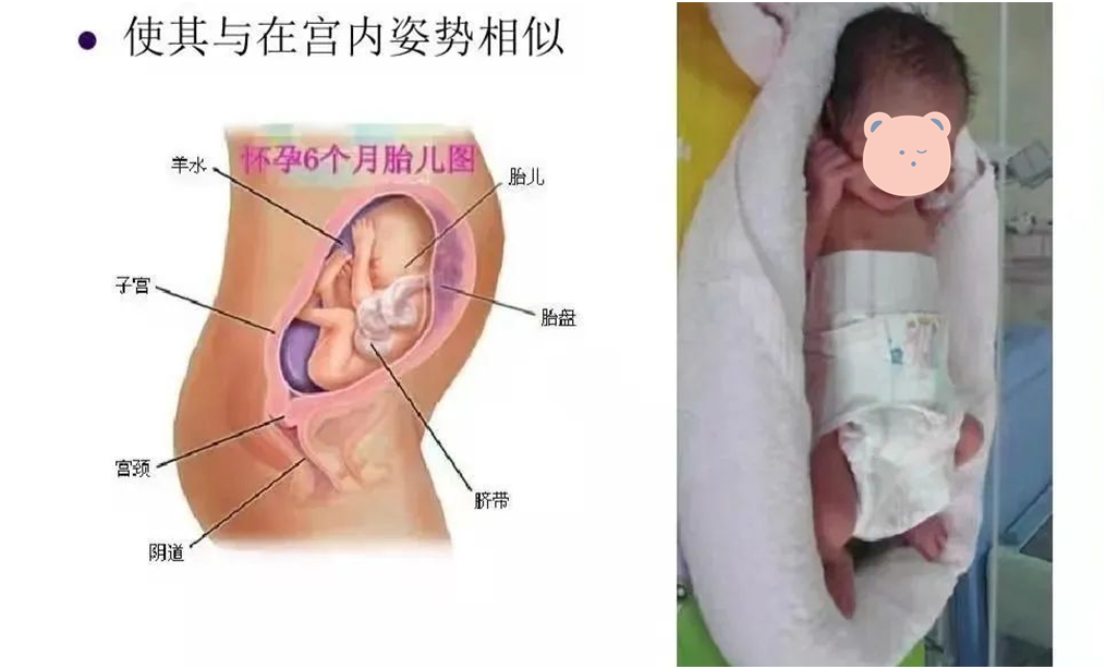 罗医新生儿科：早产儿「鸟巢」，你知道多少？