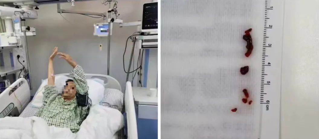 出院后，还打麻将吗？小心血栓