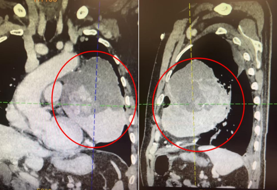 133 mm 巨大肿瘤！摘除了！