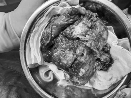 133 mm 巨大肿瘤！摘除了！