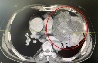 133 mm 巨大肿瘤！摘除了！