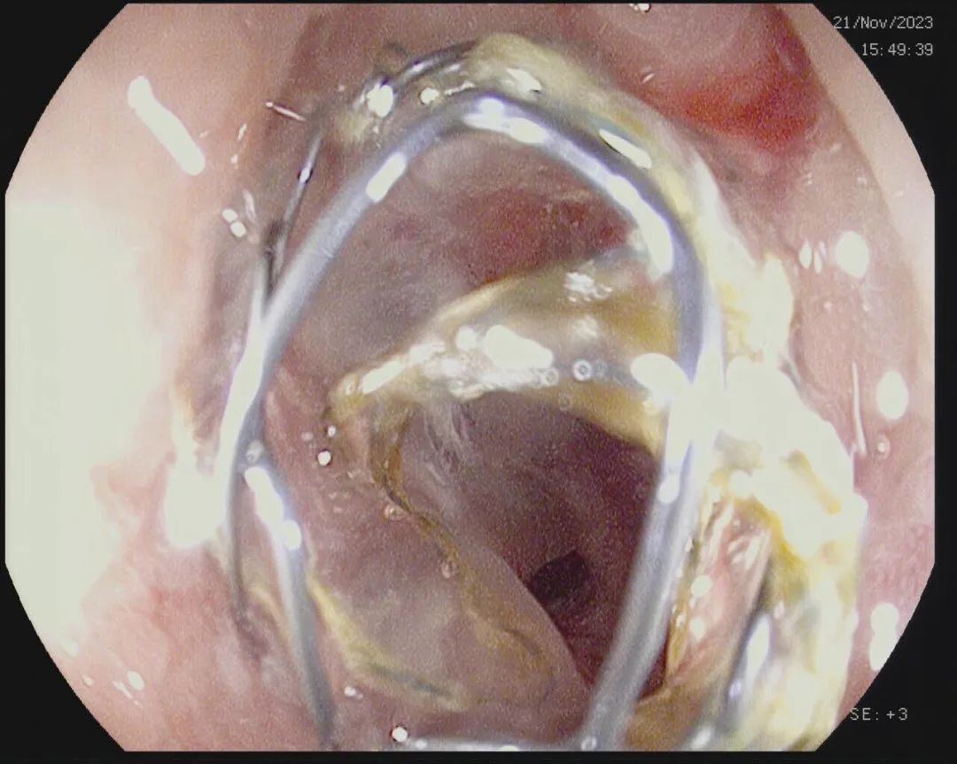 肠道支架打通「生命通道」——延安市中医医院消化内科肠道支架技术再上新台阶