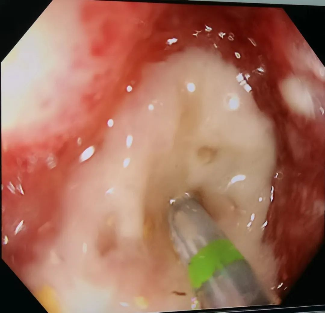 肠道支架打通「生命通道」——延安市中医医院消化内科肠道支架技术再上新台阶
