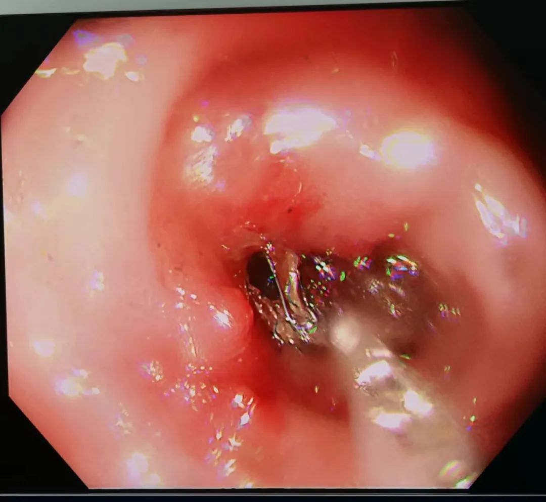肠道支架打通「生命通道」——延安市中医医院消化内科肠道支架技术再上新台阶