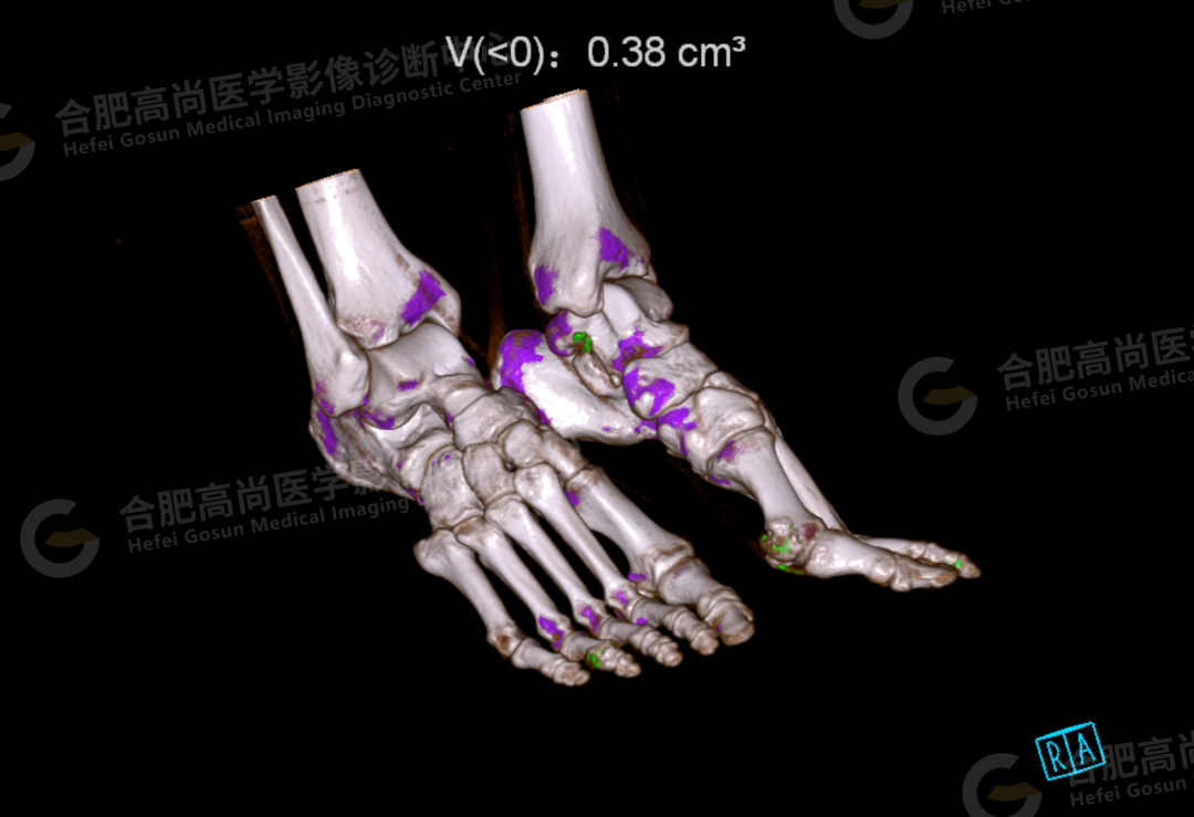 【高尚病例】双能量 CT 让痛风石无处遁形！