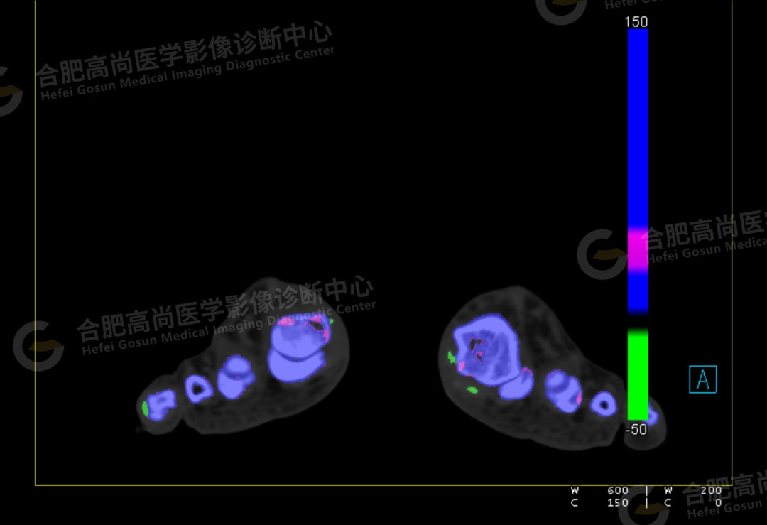 【高尚病例】双能量 CT 让痛风石无处遁形！