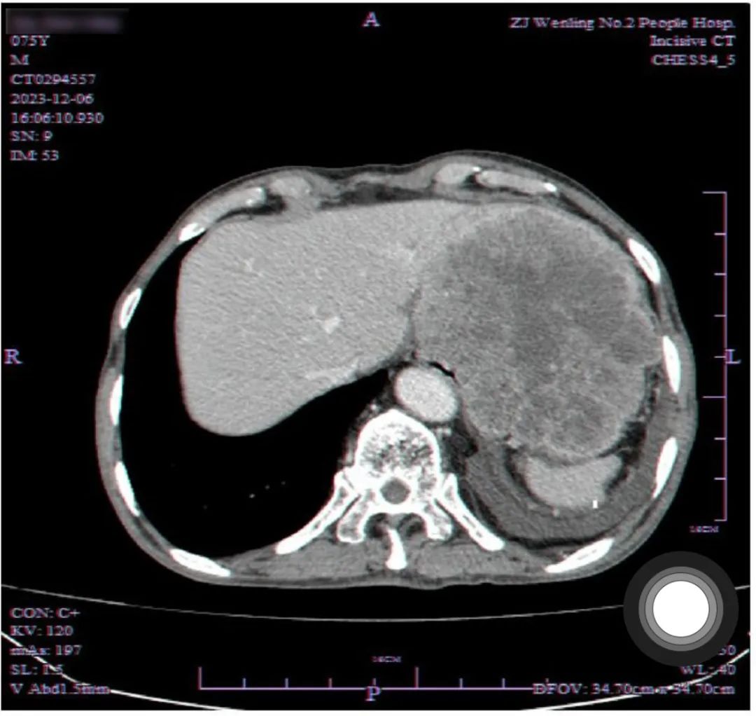 七旬老人 1 个月体重骤降 10 斤，体内竟藏着重达 4 斤的肿瘤！