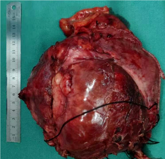 七旬老人 1 个月体重骤降 10 斤，体内竟藏着重达 4 斤的肿瘤！