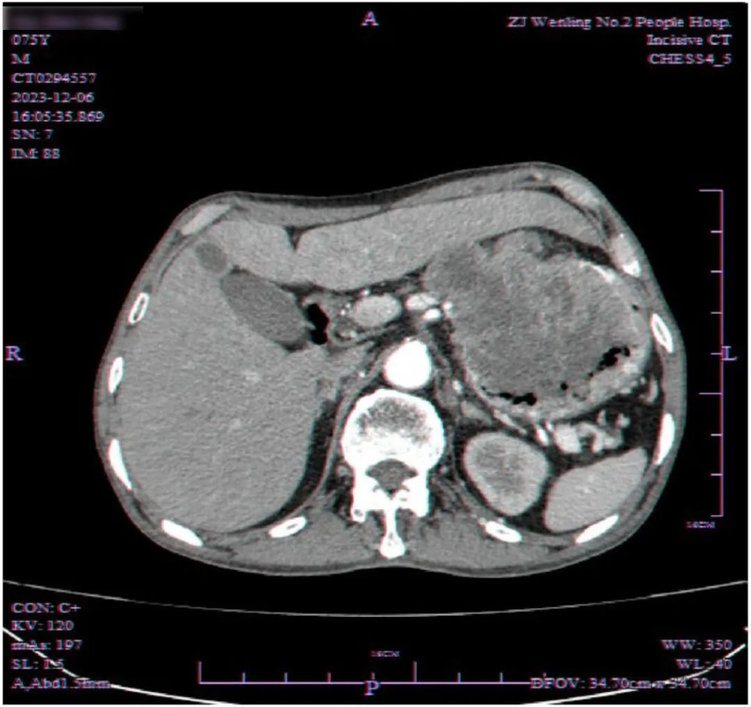 七旬老人 1 个月体重骤降 10 斤，体内竟藏着重达 4 斤的肿瘤！