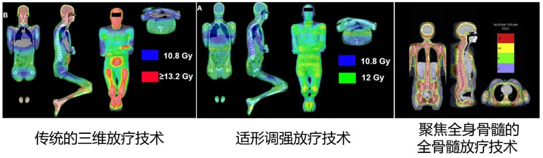 全身放疗 —— 骨髓移植前预处理的重要组成部分