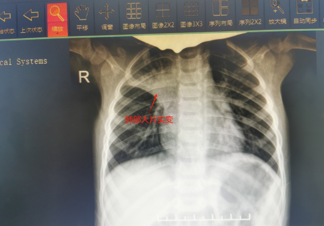 2 岁女娃高烧不退查出「白肺」!医生从肺部取出这些......
