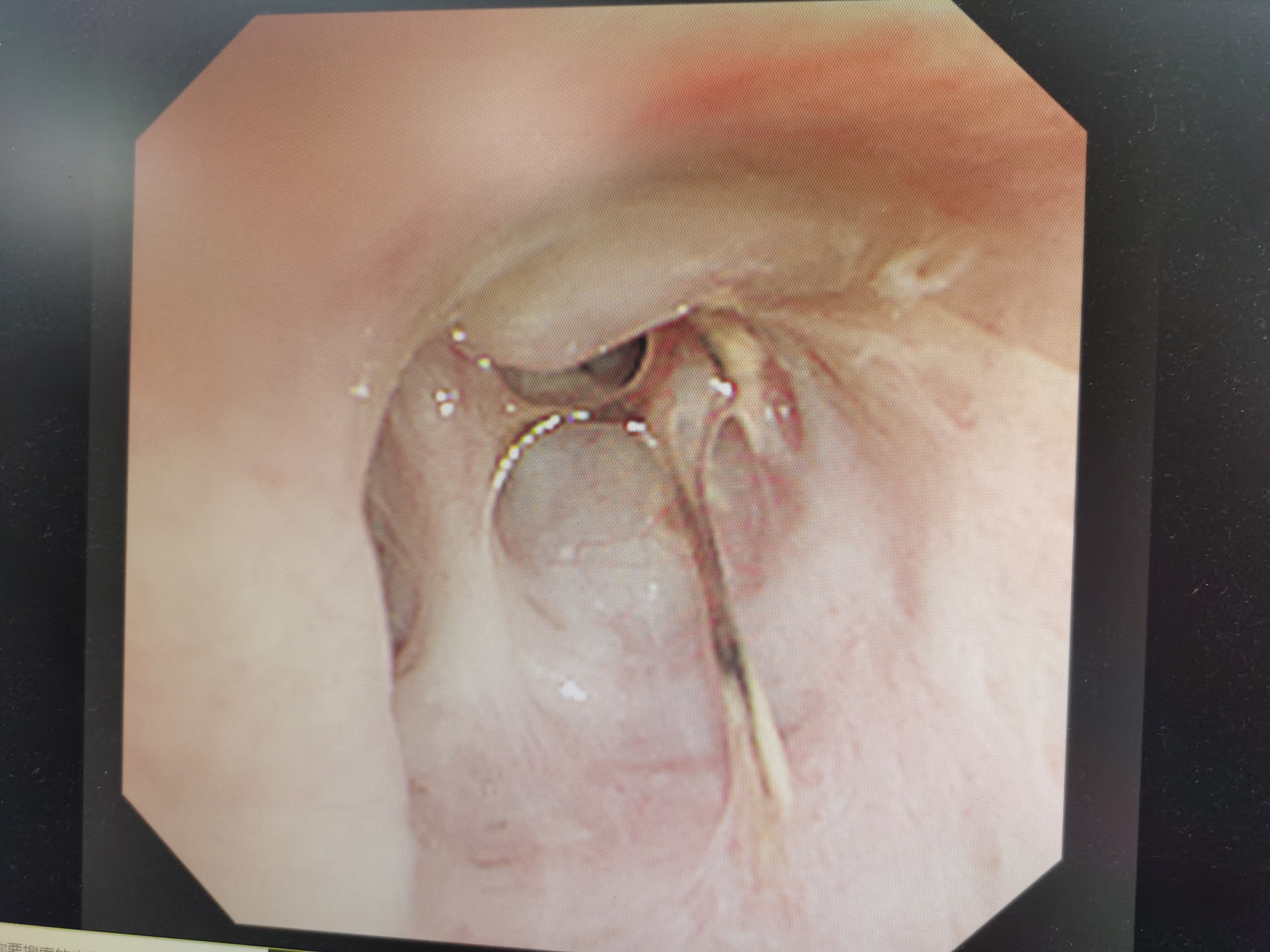 肺癌患者又染「传染性癌症」！医生连创胸外科领域三大惊喜成功「修改生死簿」