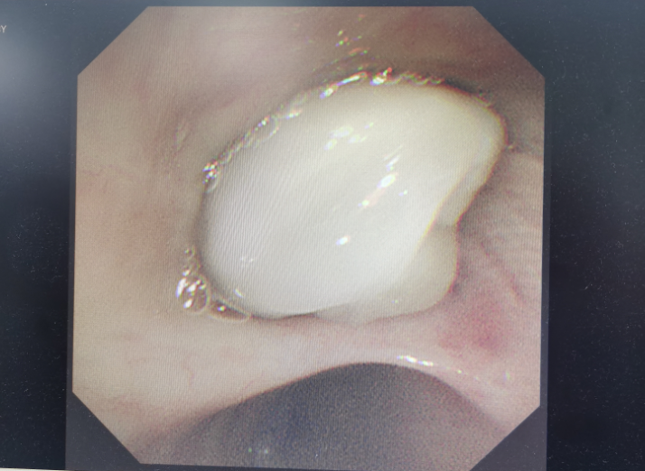 肺癌患者又染「传染性癌症」！医生连创胸外科领域三大惊喜成功「修改生死簿」