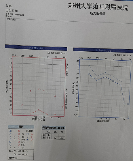 突发性耳聋：一场突如其来的听力下降