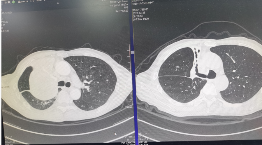 肺癌患者又染「传染性癌症」！医生连创胸外科领域三大惊喜成功「修改生死簿」