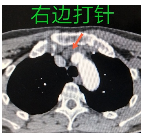 胳膊抽血还分左右？迷信还是科学？