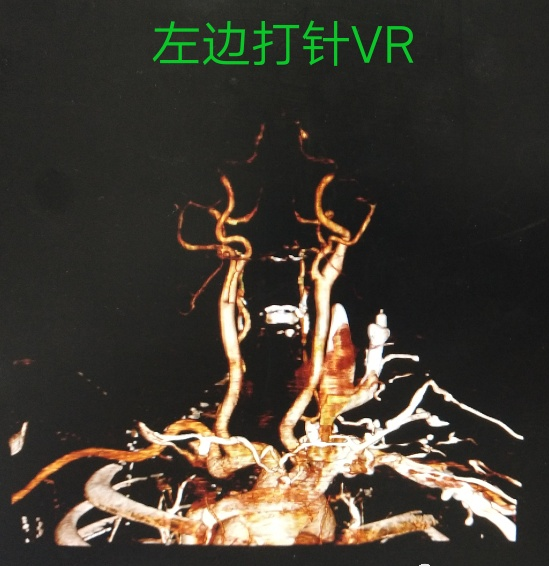 胳膊抽血还分左右？迷信还是科学？