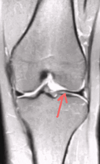 要小心,腿伸不直还「咔咔」响!这种先天畸形不少见