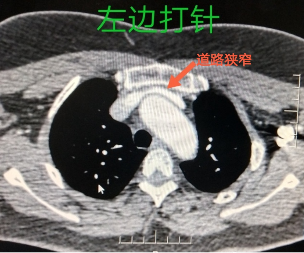 胳膊抽血还分左右？迷信还是科学？