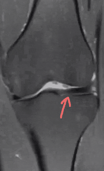 要小心,腿伸不直还「咔咔」响!这种先天畸形不少见