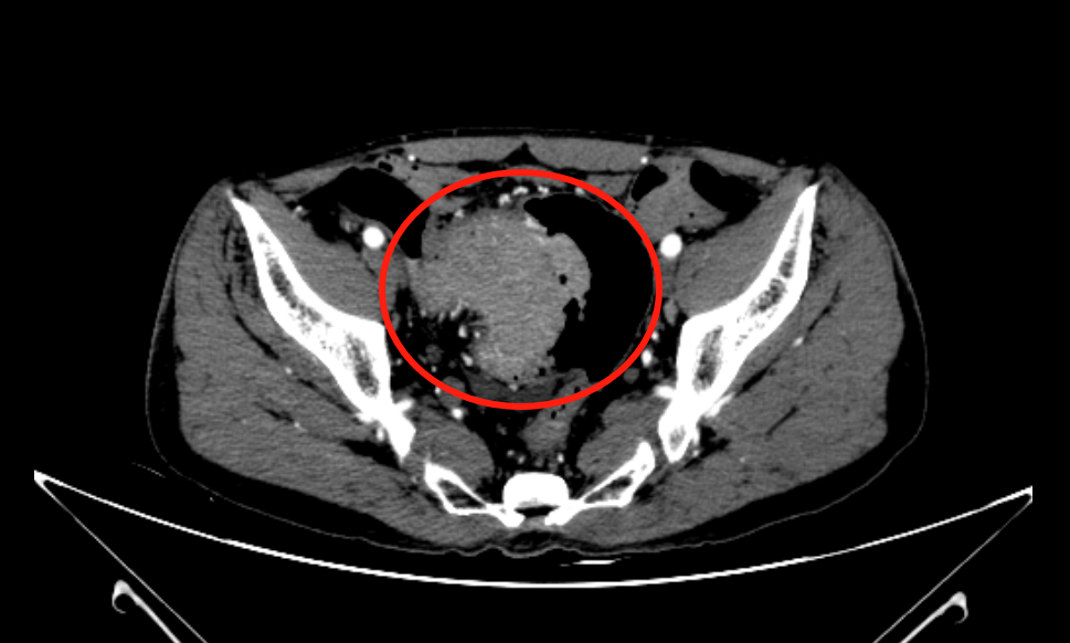 再见「肿瘤君」！罗医普外科医生一次手术切除四处肿瘤