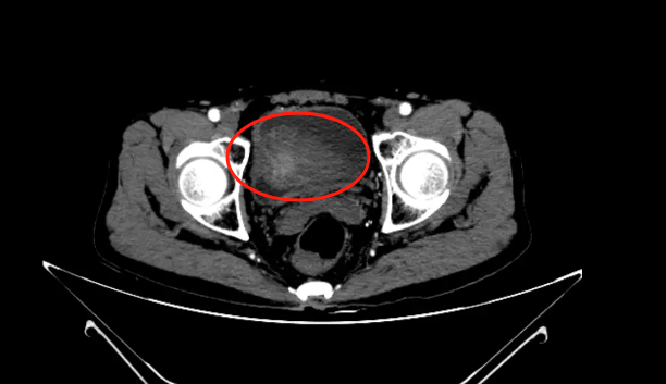再见「肿瘤君」！罗医普外科医生一次手术切除四处肿瘤