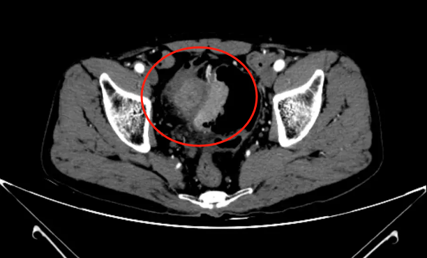 再见「肿瘤君」！罗医普外科医生一次手术切除四处肿瘤