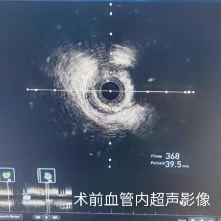 突破!河北医科大学第一医院「零造影剂」为患者行冠脉支架植入术