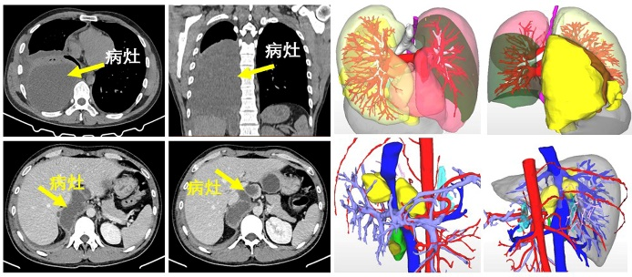 西藏阜康医院多学科协作成功实施首例胸腹腔病损切除术