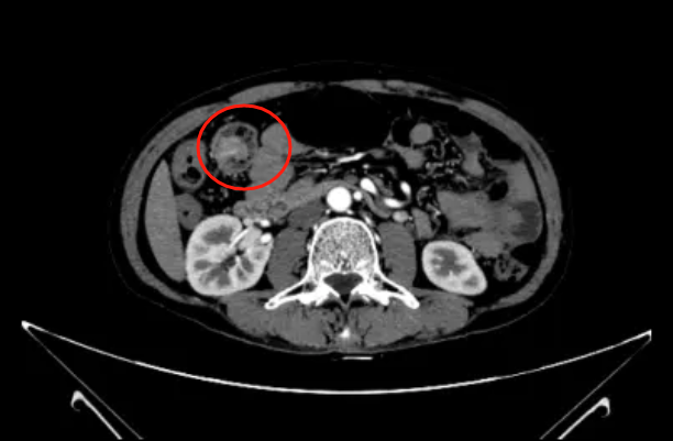 再见「肿瘤君」！罗医普外科医生一次手术切除四处肿瘤