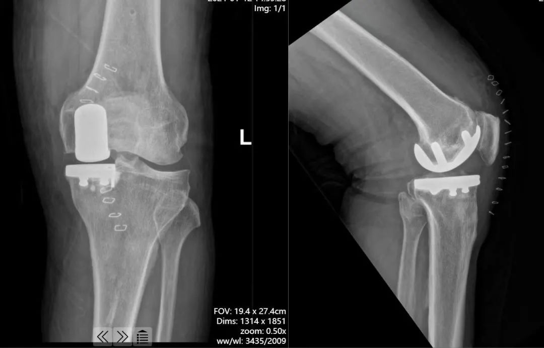 河北省首例！河北医科大学第一医院机器人辅助膝关节单髁置换手术！