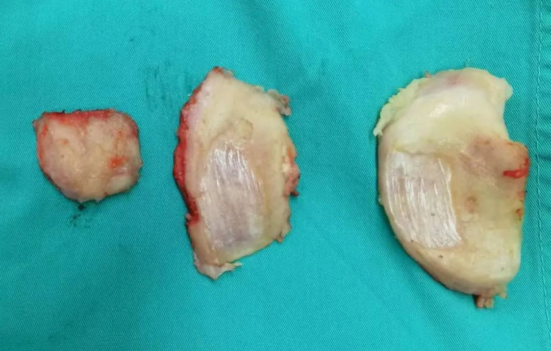 河北省首例！河北医科大学第一医院机器人辅助膝关节单髁置换手术！