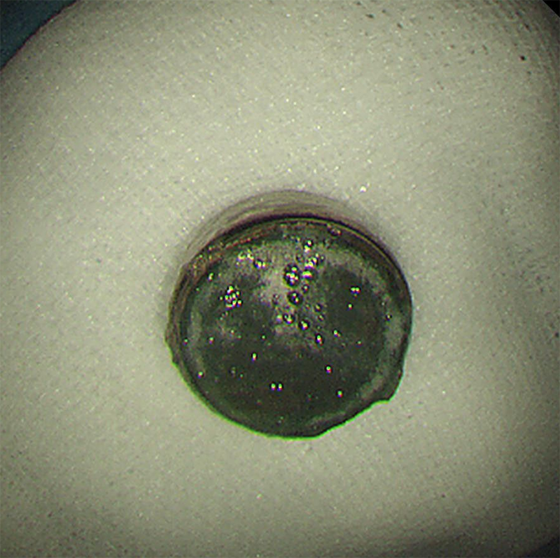 婴儿误吞纽扣电池，鲁中医院妙手取出