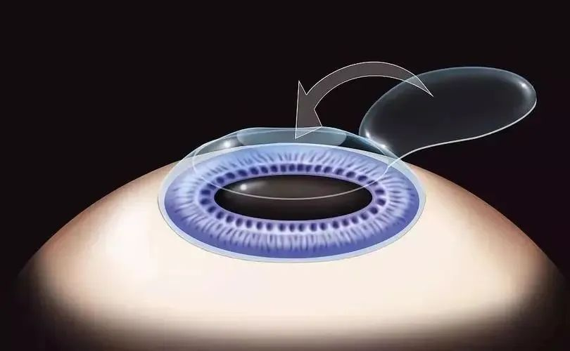 湖北普瑞眼科医院科普|圆锥角膜:无法做近视手术的「伪装者」!