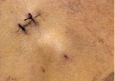 守护患者「隐形生命线」, 让长期输液不再痛苦