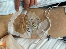 守护患者「隐形生命线」, 让长期输液不再痛苦