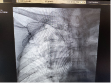 守护患者「隐形生命线」, 让长期输液不再痛苦