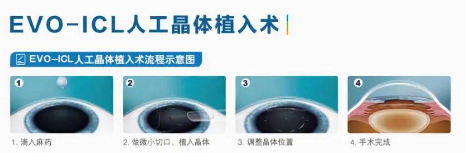 湖北普瑞眼科医院科普｜ICL 晶体植入术的几大谣言，这也太假了！